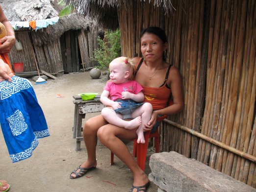An Albino Child and
        her mother